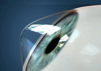 Polispecialistico Maragliano - dott. Sergio Petroni - Cheratocono