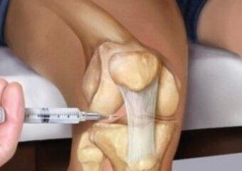 Polispecialistico Maragliano - dott. Paolo Sorani - L'acido ialuronico