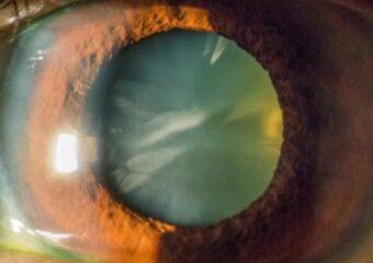 Polispecialistico Maragliano - dott. Sergio Petroni - Cataratta