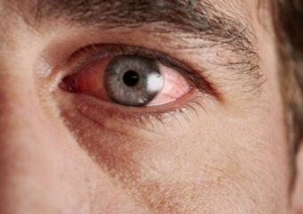 Polispecialistico Maragliano - dott. Sergio Petroni - Congiuntivite Allergica