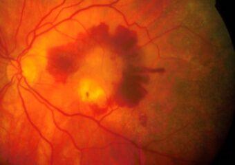 Polispecialistico Maragliano - dott. Sergio Petroni - La Degenerazione Maculare